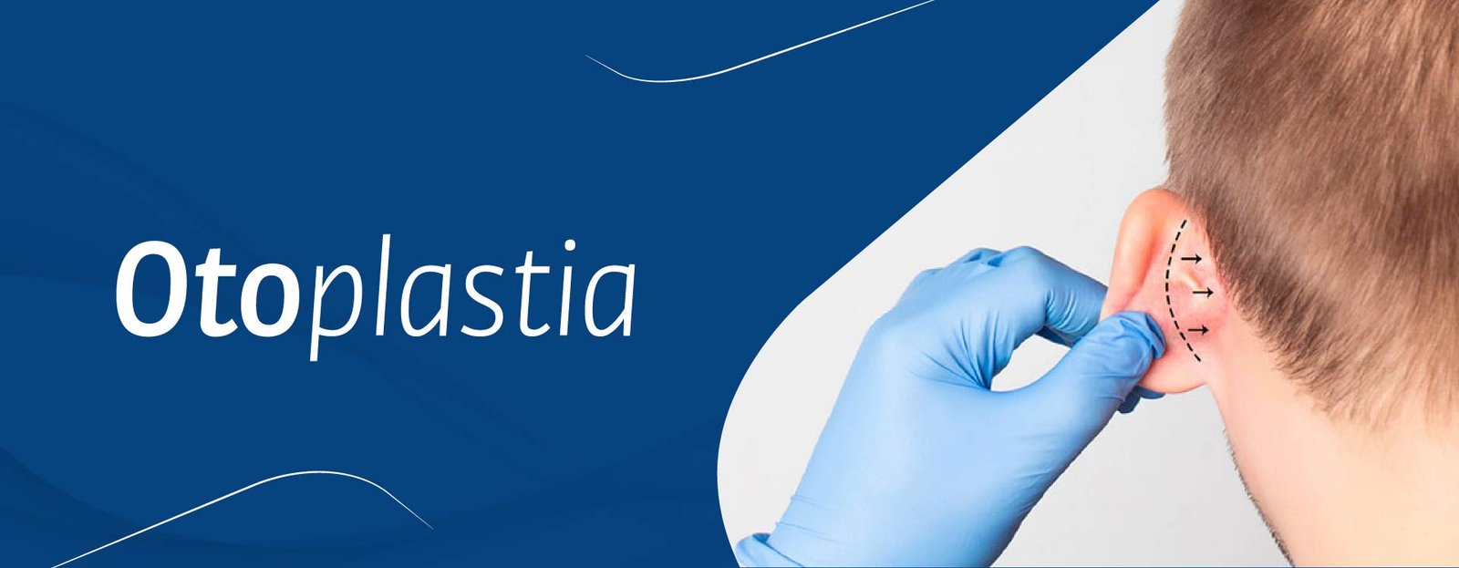 Otoplastia